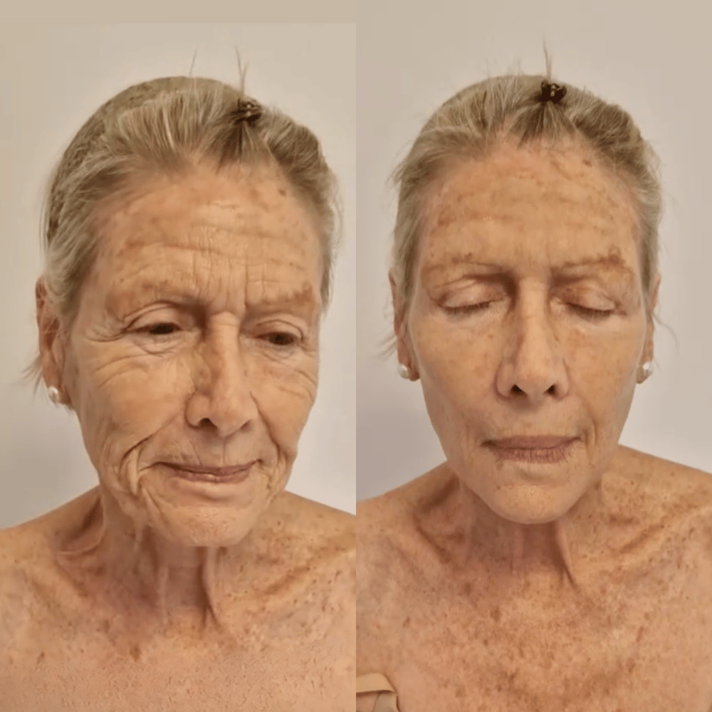Prima e dopo con Velvionna K-Lift