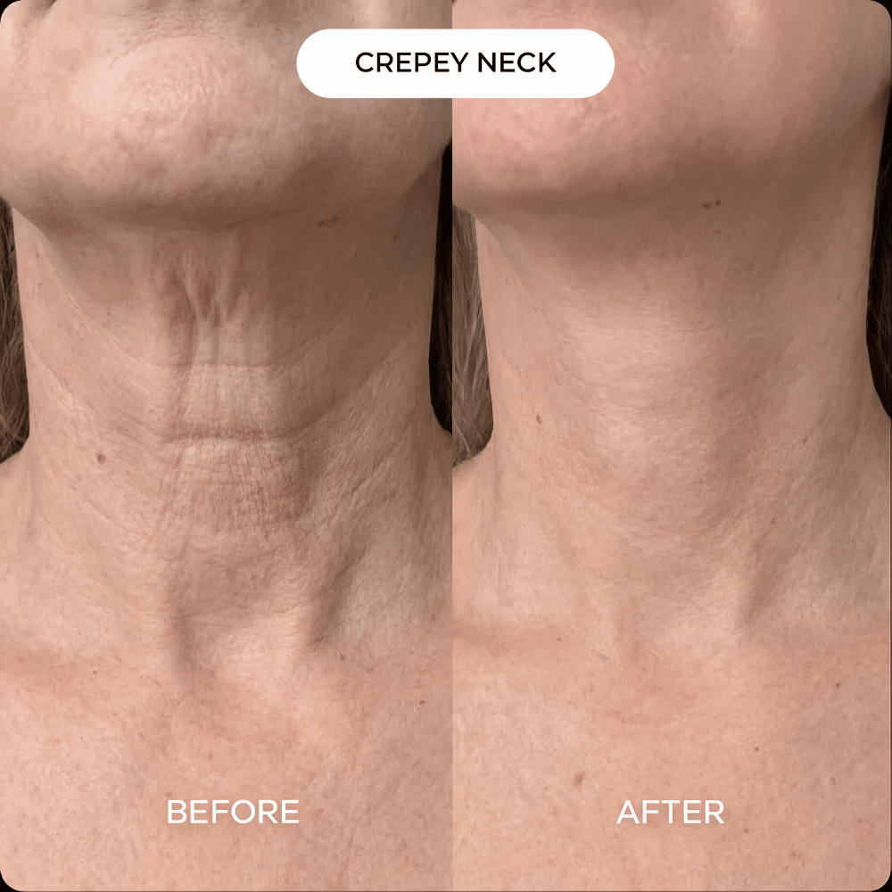 Neck & Décolleté PDRN mask (3-pack)