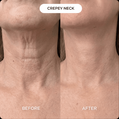 Neck & Décolleté PDRN mask (3-pack)