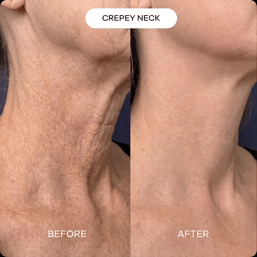 Neck & Décolleté PDRN mask (3-pack)