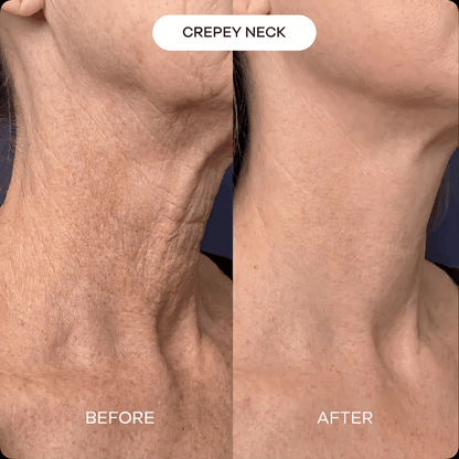 Neck & Décolleté PDRN mask (3-pack)