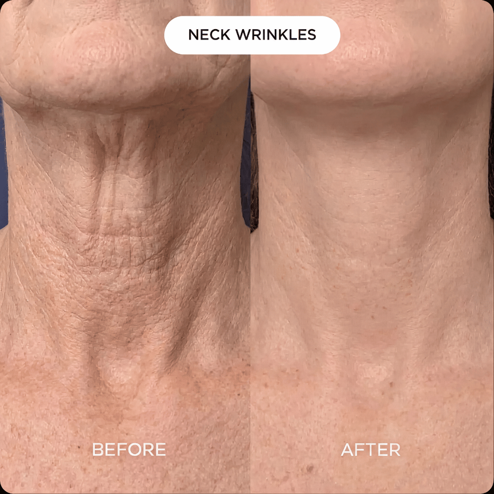 Neck & Décolleté PDRN mask (3-pack)