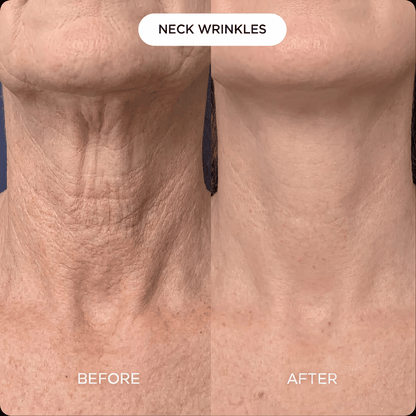 Neck & Décolleté PDRN mask (3-pack)