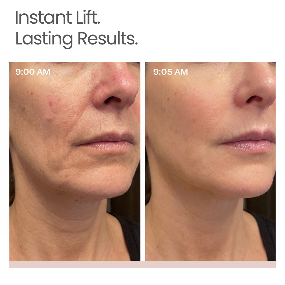 Prima e dopo, lifting visibile