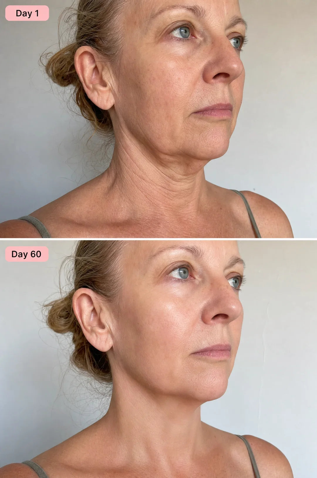 Neck and jawline before and after
